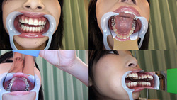 【歯フェチ】ゆあちゃんの美しい歯並びとキラっと光る銀歯を観察！