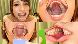 【歯フェチ】うみちゃんの矯正中の歯を観察！【広瀬うみ】